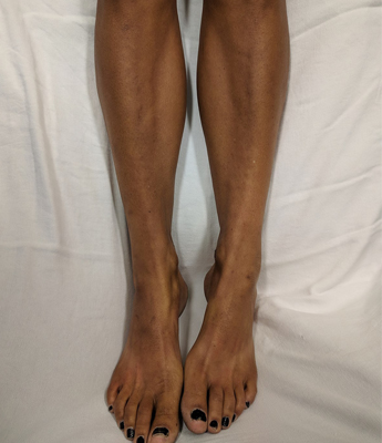 Addison's disease