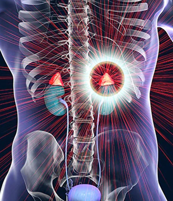 CONN's syndrome