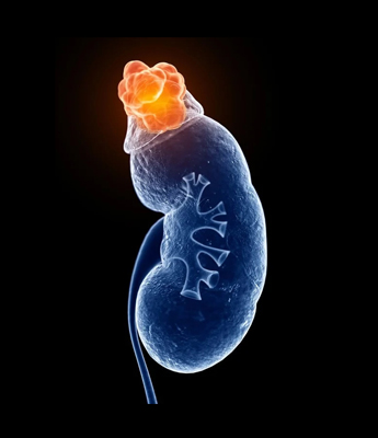 Adrenal carcinoma