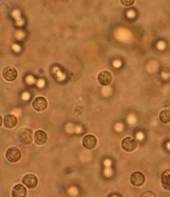 Evaluation of recurrent urine tract infection