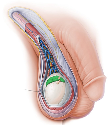 Evaluation of absent testis (one side/both side)