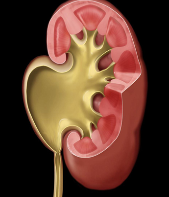 Paediatric kidney fullness correction (PUJO)