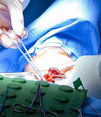 Paediatric endoscopic stone surgeries