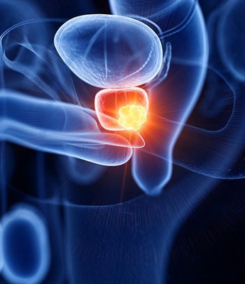 Stricture of urethra