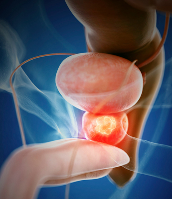 Urethral cancer