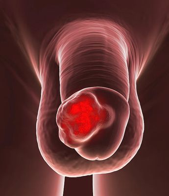 Cancer of penis