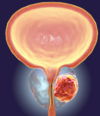 Cancer of prostate